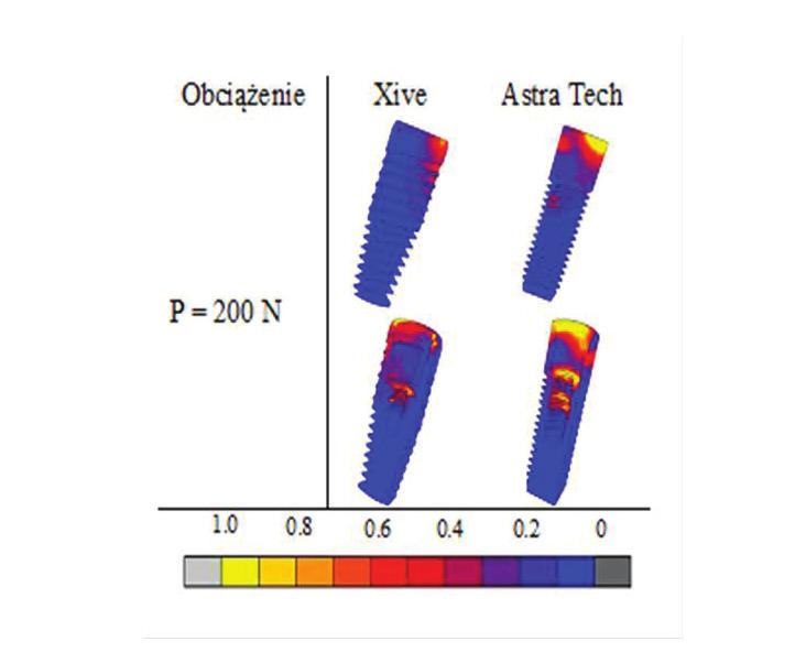 Podobnie, różnice zarówno w wartościach naprężeń jak i ich rozkładzie widoczne są w implantach Xive i Astra (ryc. 9). Implantoprotetyka Ryc. 9. Rozkład normalizowanego wskaźnika naprężenia k w implantach.