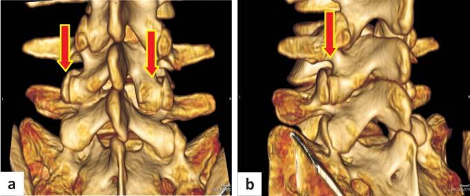 Clinical and radiological assessment of interspinous stabilization using inswing implant 91 DIAGNOSTIC TESTING 1.