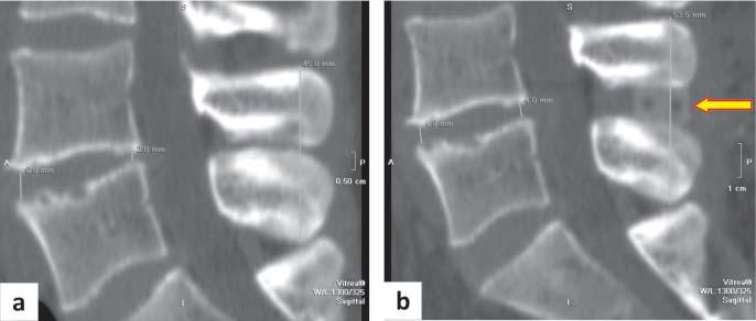 the stabilizer (spinous processes appearance, condition of vertebral arches). BADANIA DIAGNOSTYCZNE 1.