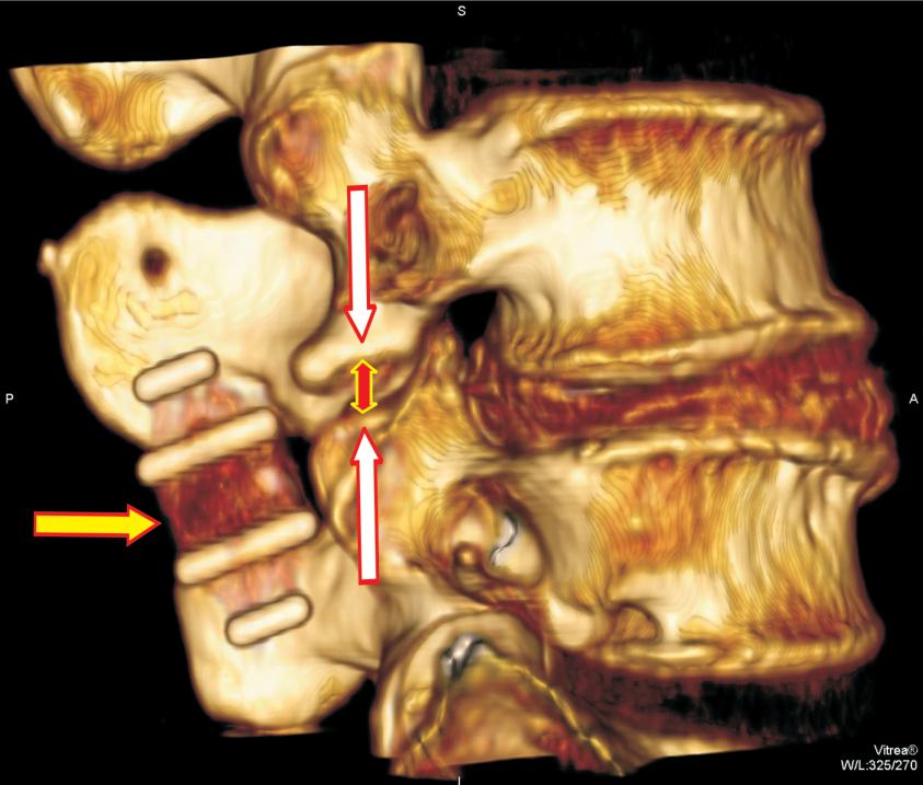 Clinical and radiological assessment of interspinous stabilization using inswing implant 1.