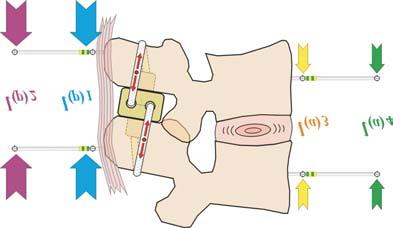 Clinical and radiological assessment of interspinous stabilization using inswing implant 95 5.