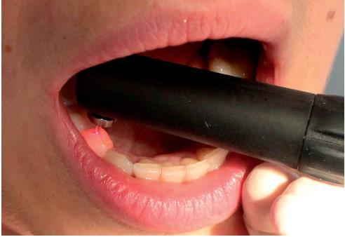 4 Rys. Badanie powierzchni zgryzowej zęba 44 urządzeniem DIAGNOdent pen.