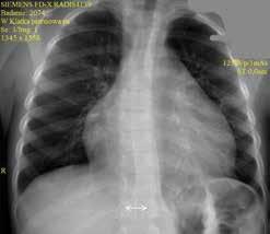 Opis przypadku Chłopiec 5-letni, przyjęty do oddziału pediatrycznego z powodu utrzymującej się od trzech dni gorączki 38 39 C i niewielkich dolegliwości bólowych klatki piersiowej, nasilających się w