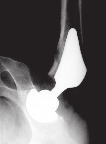 Tomaszewski W. et al., Evaluation of outcomes of hip arthroplasty kości udowej (Ryc.