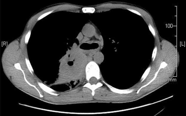 stawie obrazu klinicznego, radiologicznego oraz histopatologicznego wycinka z oskrzela rozpoznano GPA.