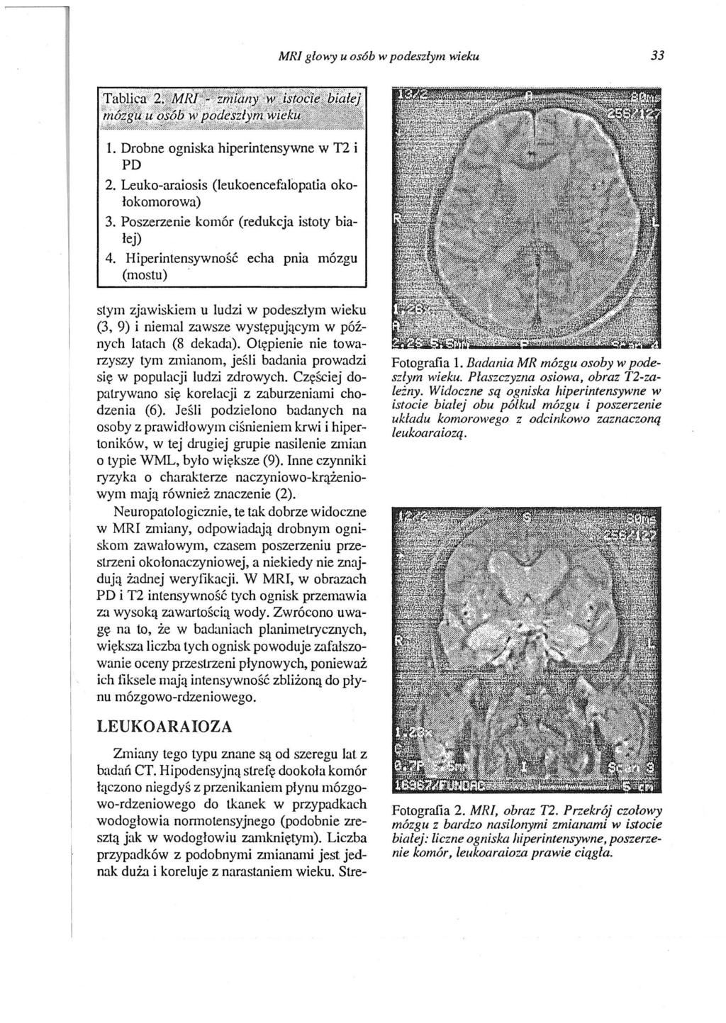 MRI glo".,y u osób w podeszłym wieku 33 1. Drobne ogniska hiperintensywne w T2 i PD 2. Leuko-araiosis (leukoencefalopatia okołokomorowa) 3. Poszerzenie komór (redukcja istoty białej) 4.