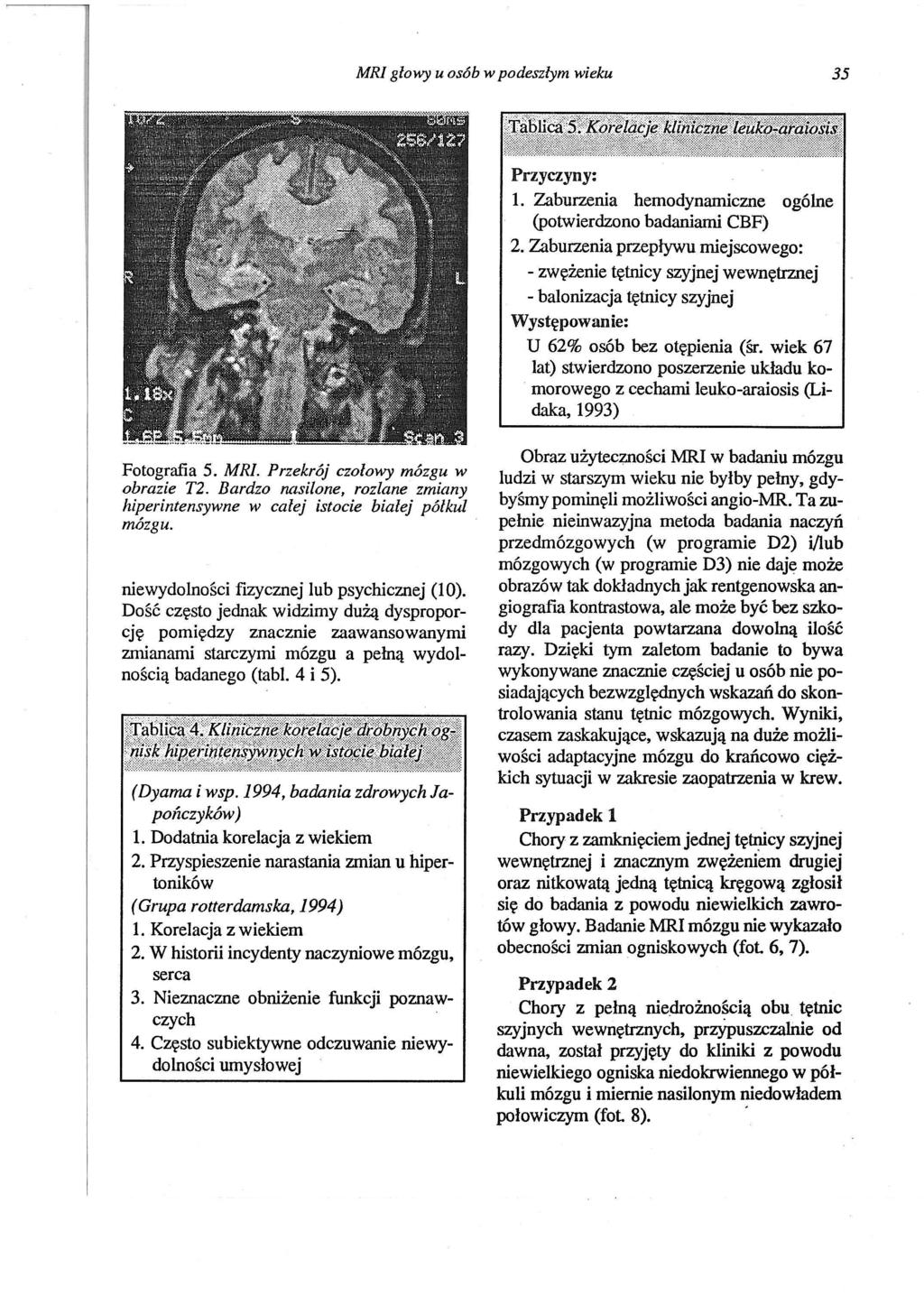 MRI głowy u osób w podeszłym wieku 35 Przyczyny: 1. Zaburzenia hemodynamiczne ogólne (potwierdzono badaniami CBF) 2.
