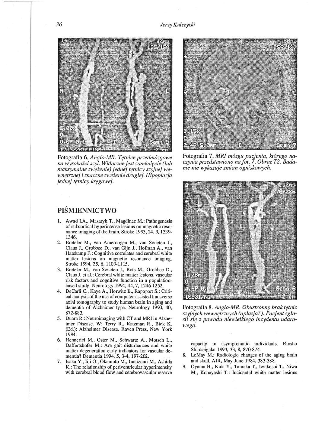 36 Jerzy Kulczycki Fotografia 6. Angio-MR. Tętnice przedmózgowe na wysokości szyi. Widoczne jest zamknięcie (lub maksymalne z"vlyżenie) jednej tętnicy szyjnej wewnętrznej i znaczne zwężenie drugiej.