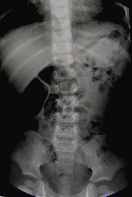 Urografia: zawsze poprzedzona zdjęciem przeglądowym po dożylnym podaniu jodowego środka kontrastowego (1ml/kg - 2 ml/kg masy ciała) wykonuje się serię zdjęć jamy brzusznej w pozycji