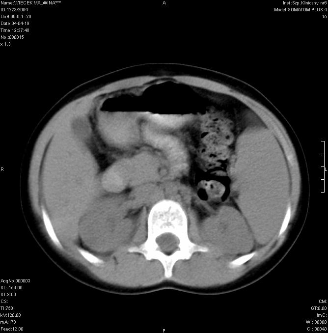 Tomografia komputerowa: TK nerki