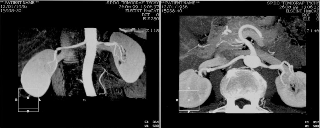 Angiografia TK Rekonstrukcja: