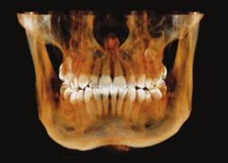 najlepsze oprogramowanie 2D VixWin lub CLINIVIEW oraz 3D InVivo Dental dla jeszcze lepszej diagnostyki i precyzyjnego planowania zabiegów 9 x 14 cm Maksymalne pole obrazowania CBCT premiera 2017