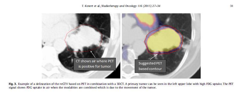 2015]; wykorzystanie do konturowania artykuły z NSCLC - regtv respiration