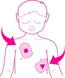 b. Jeżeli klatka piersiowa dziecka jest wystarczająco duża, aby pomiędzy elektrodami była 2,5 cm przerwa, elektrody można umieścić w podobny sposób jak u osoby dorosłej.