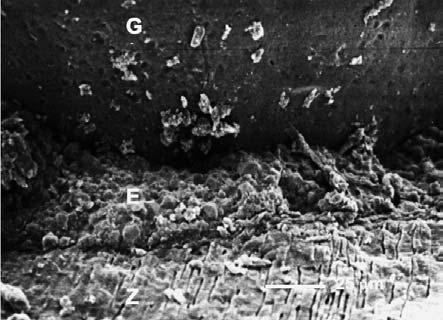 Ząb wypełniony techniką pojedynczego ćwie ka. Sealer (E), zębina (Z), gutaperka (G) Fig. 7.