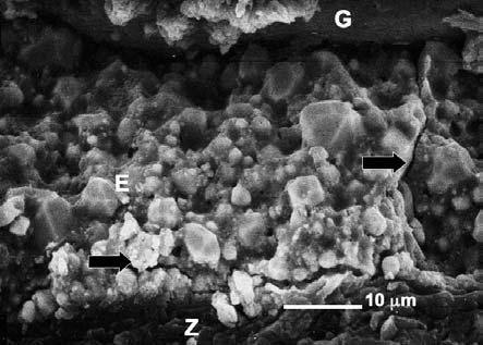 Sealer (E), dentine (Z) and gutta percha (G) are visible Ryc. 5. Ząb wypełniony techniką kondensacji bocznej.