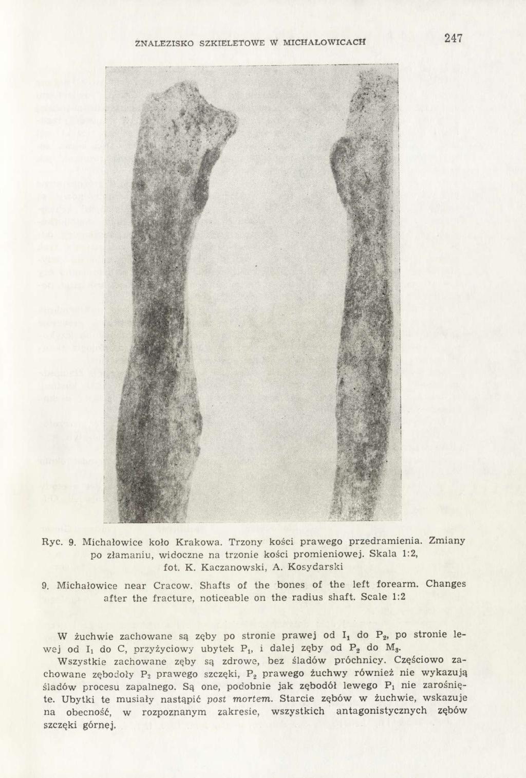 ZNALEZISKO SZKIELETOWE W MICHAŁOWICACH 247 Ryc. 9. Michałowice koło Krakowa. Trzony kości prawego przedramienia. Zmiany po złamaniu, widoczne na trzonie kości promieniowej. Skala 1:2, fot. K. Kaczanowski, A.