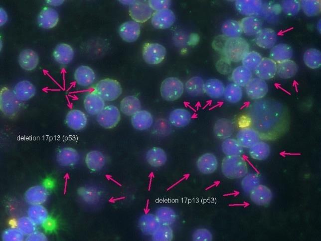 Definicja PBL wysokiego ryzyka Del17p / mutacja TP53 (chorzy nieleczeni i leczeni, ze wskazaniami do leczenia) Oporność na