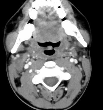 Results End of treatment Residual neck mass after