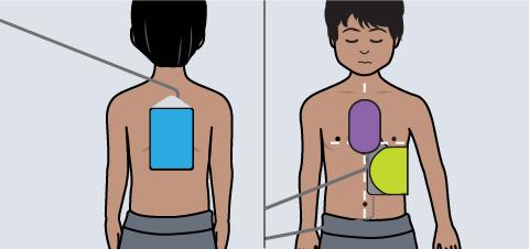 Również grafika na ekranie wyświetlacza przedstawia umieszczenie elektrody. LUB Umieszczenie elektrod u pacjenta dorosłego Umieszczenie elektrod udziecka OSTRZEŻENIE!