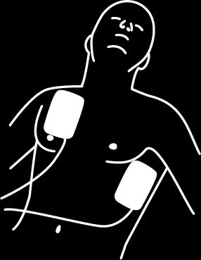 Udzielanie pomocy pacjentowi, u którego doszło do nagłego zatrzymania krążenia 9 Przymocować elektrody do odsłoniętej klatki piersiowej pacjenta w sposób pokazany na rysunkach na elektrodach.