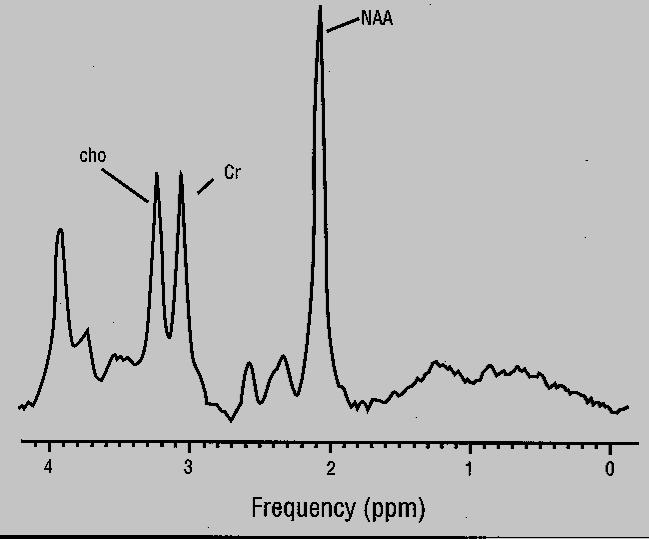 Protonowa spektroskopia MR nieinwazyjne oznaczenie niektórych metabolitów : lipidy, mleczany, inozytol, cholina, kreatyna,