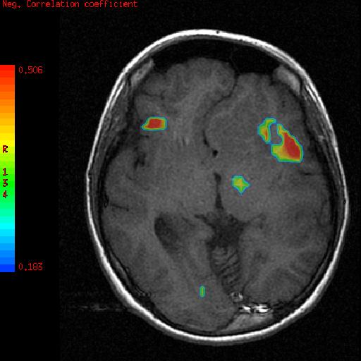 fmri mr FUNKCJONALNE Badanie aktywności mózgu na