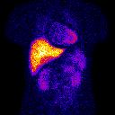 Tomograia SPECT (Single Photon Emission Computed Tomography)