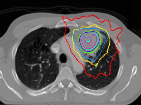 Chemioterapia i hypofrakcjonowana radioterapia: PET Boost trial (ongoing) Concurrent chemo-radiotherapy.