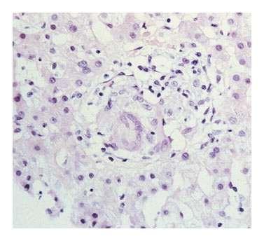 Barza MJ et al. N Engl J Med 1998;339:831-837.