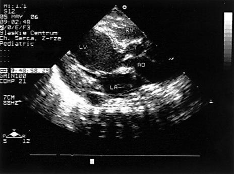 Strzałką zaznaczono miejsce połączenia tunelu (T) z aortą (Ao); LV (left ventricle) lewa komora, LA (left atrium) lewy przedsionek, RV (right ventricle) prawa komora Rycina 4.