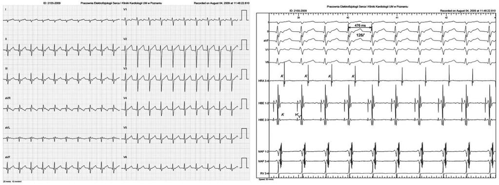 Małaczyńska-Rajpold K., Błaszyk K., Koźluk E. et al. Atrioventricular nodal reentrant tachycardia Pol Przegl Kardiol. 2012;14(3): 196-203 RYCINA 6. FIGURE 6. Pacjentka S.B. (lat 19).