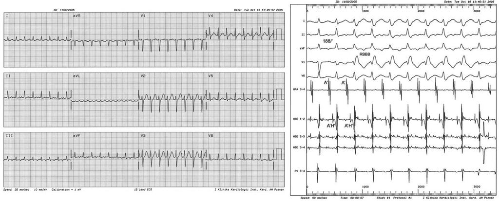 W zapisie EKG widoczny załamek P za zespołem QRS, co potwierdzono obecnością załamka A (panel B) w zapisie wewnątrzsercowym (zapis 50 mm/s) Female S.B. (19 y/o).