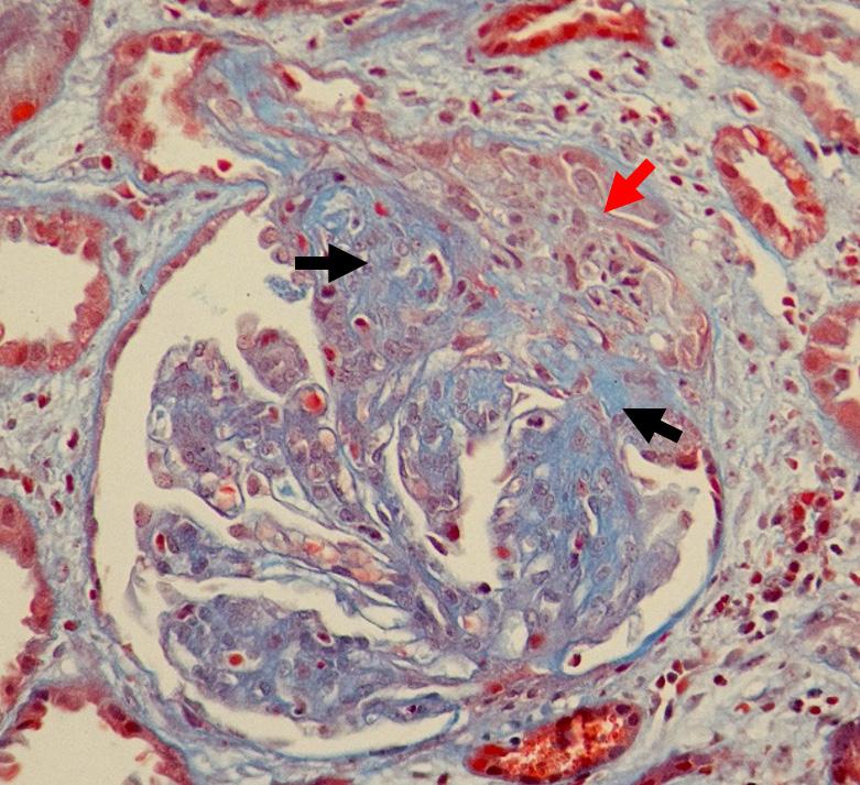 krwionośnych, - w IFL i ME złogi kompleksów immunologicznych (w IFL zwykle świecenie typu Rycina 1 przeciwciałami ANCA. W obu kłębuszkach widoczne są segmentalne półksiężyce komórkowe (strzałki).