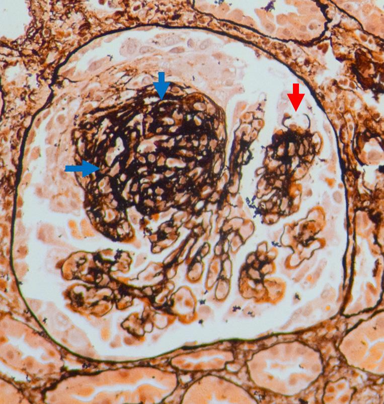 Rycina 2 Martwicze pauci immune zapalenie kłębuszków w przebiegu zapalenia naczyń z przeciwciałami ANCA.