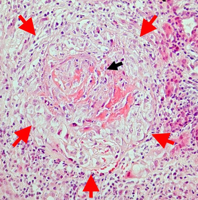 Pauci immune necrotizing glomerulonephritis associated with ANCA vasculitis. A fibro-cellular crescent (red arrow) and secondary segmental glomerulosclerosis (black arrows) are seen. AFOG staining.