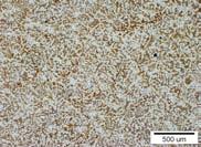 The X-ray diifraction pattern of Mg-8,2%Li-4,7%Ca alloy Stop dwufazowy α+β; 7,57% Li, 4,4% Al Struktury tego stopu wraz z analizą składu chemicznego w mikroobszarach charakterystycznych