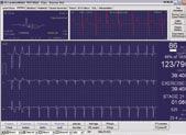 W celu zachowania spójności z danymi gromadzonymi za pomocą aplikacji CardioSoft s Resting ECG, aplikacja Exercise Stress Testing wykorzystuje te same najwyższej jakości programy analizy zapisów EKG