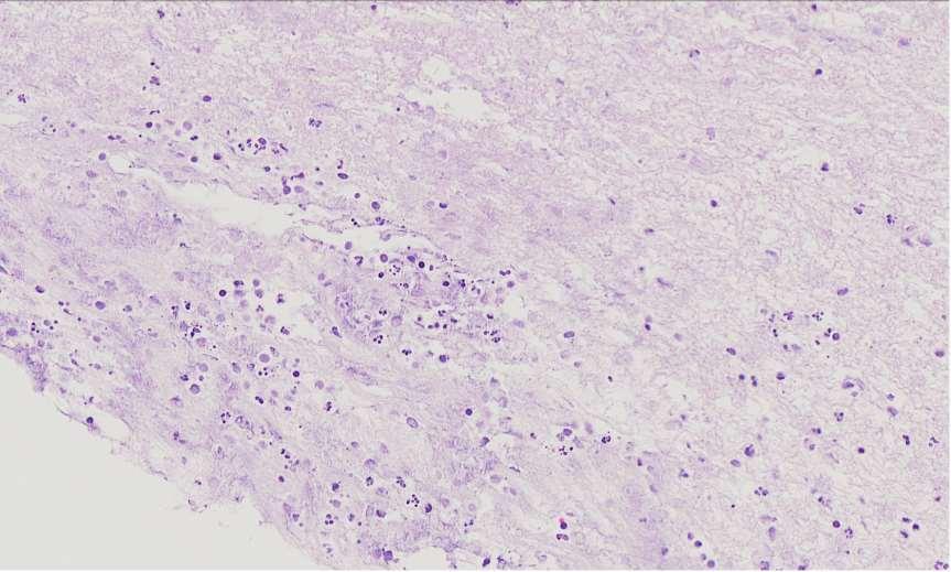 Badanie histopatologiczne biopsja