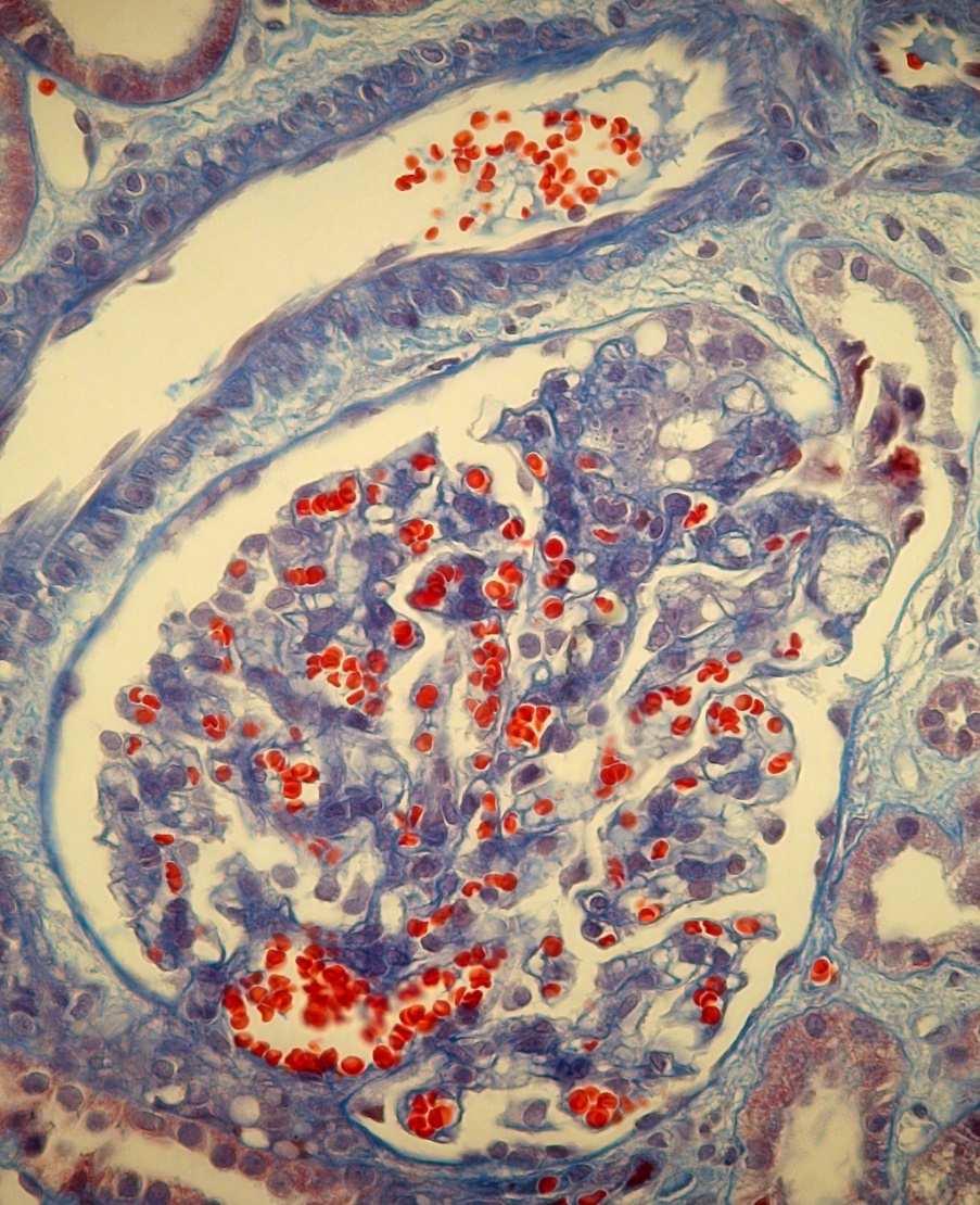 FSGS - wczesna faza Mezangioliza, obecność