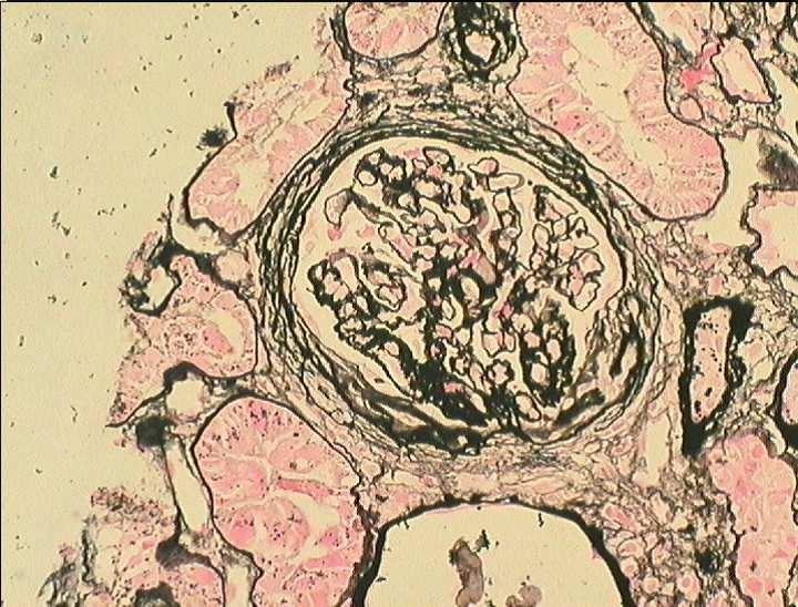 FSGS wariant przywnękowy Twardnienie wokół