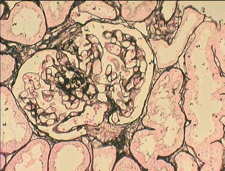 FSGS wariant NOS Srebrzenie