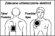 INSTRUKCJA UżYTKOWNIKA Synchroniczna kardiowersja w przypadku migotania przedsionków Skuteczność kardiowersji migotania przedsionków oraz ogólna skuteczność kliniczna jest wyższa, jeżeli stosuje się