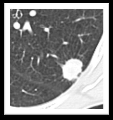 Wysycenie guzków Guzek lity (solid nodule, SN):