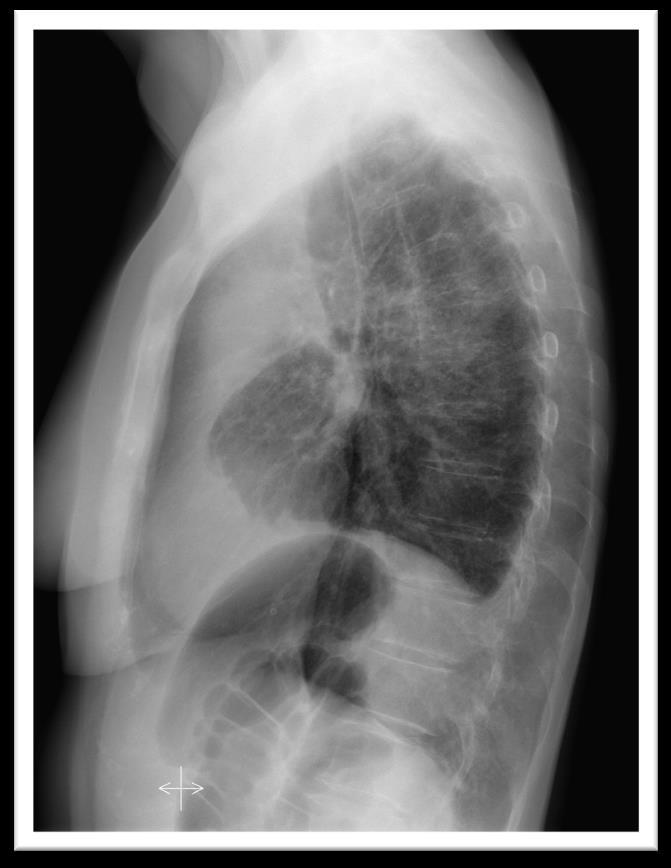 rentgenowskie klatki piersiowej w pozycji