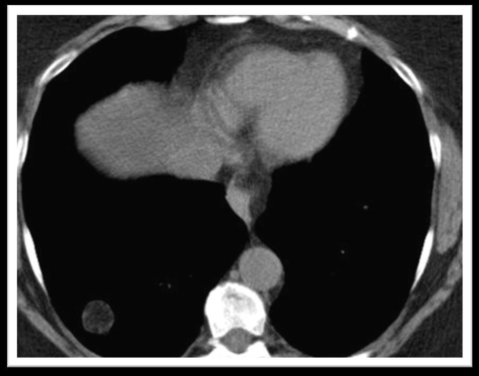 Pojedynczy cień okrągły w płucu : to zmiana radiologiczna powodowana przez guzek o kształcie zbliżonym do kulistego średnicy w największym wymiarze < 3 cm położony w obrębie