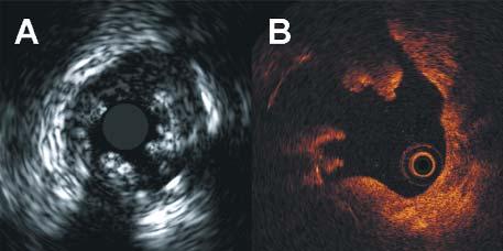 Regar E, van Leeuwen TG, Serruys PW (eds.). Informa Helthcare 2007: 95-102. OCT IVUS Ryc. 1. Stent uwalniaj¹cy sirolimus w 36 miesiêcy po implantacji do ga³êzi przedniej zstêpuj¹cej.