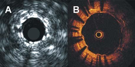 Sirolimus eluting stent in left descendending artery 36 months after the implantation.