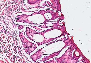 3 in the stroma of the mucous membrane, the authors observed a cyst lined by multi layered flat epithelium.