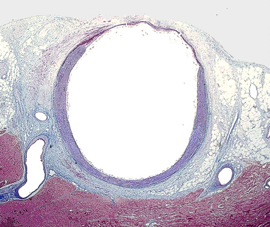 angioplastyce.